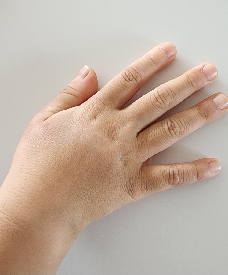 May 23rd to the 30th:  Leucopathy treatment