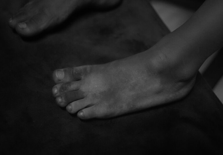 Dec 2025(for 6 months): vitiligo treatment