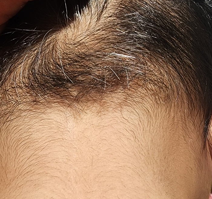 1. white hair treatment journey 💆‍♀️