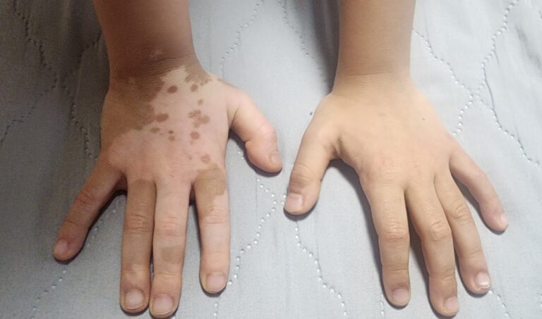 Son: Apr 2026(for 10months): Vitiligo Treatment